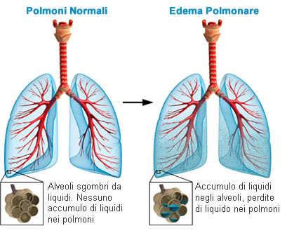 Edema polmonare Condizione causata da un eccesso di liquidi nei polmoni.