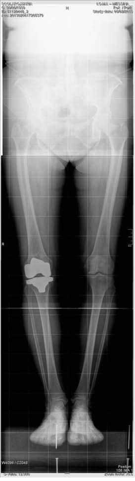 Fig. 15: Esame telemetrico degli arti inferiori a 5 anni dall intervento CONCLUSIONI attualmente uno dei problemi più dibattuti dalla comunità scientifica nell ambito della chirurgia protesica del