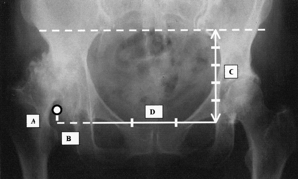 Individuazione radiografica del centro di rotazione femorale ai fini della protesizzazione di anche con esiti di displasia congenita Fig. 1. Determinazione del CRF con metodo di Pierchon et al.