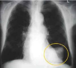 Effetti tossici del Cr(VI) nell esposizione professionale Nefrotossico: Attività precipitante le proteine Particolare