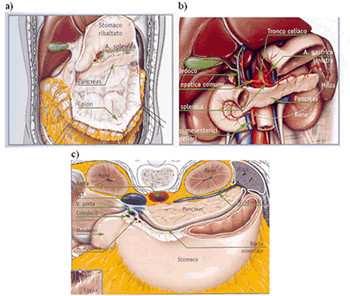 Il corpo è in rapporto anteriormente con la parete posteriore dello stomaco; posteriormente con la VMS, l aorta, la ghiandola surrenale e il rene di sinistra.