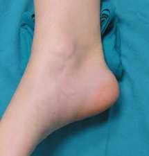 punto di incrocio con il tendine flessore lungo delle dita Didascalia: asterisco, tubercolo mediale; stella, tubercolo laterale; freccia, tendine flessore lungo