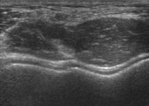Il breve tendine del muscolo brachiale può essere valutato con scansioni longitudinali sino alla sua inserzione sul processo coronoideo dell ulna 3 Utilizzare scansioni sagittali per valutare la