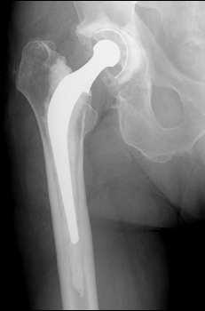 La finitura superficiale (scelta di materiali macroporosi o presenza di fori attraverso lo stelo) può svolgere un ruolo importante per l osteointegrazione delle protesi non cementate.
