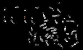 Duplicazione braccio corto del cromosoma Y crom Y normale Yp duplicato