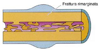 Tessuto di granulazione