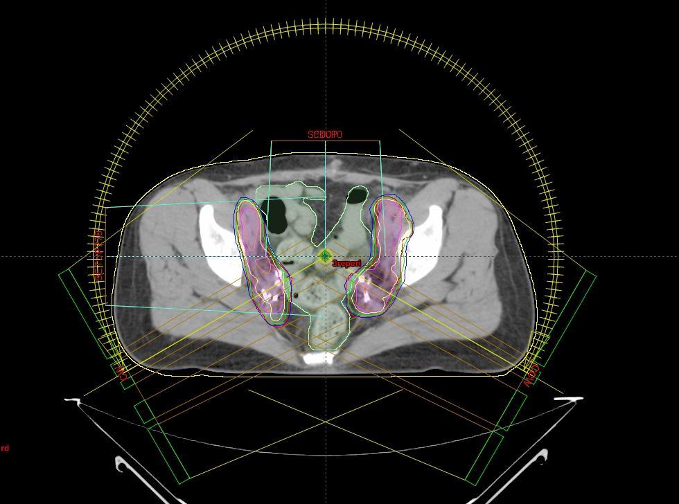 VMAT - VOLUMETRIC MODULATED ARC THERAPY: UN NUOVO CONCETTO DI IMRT MOVIMENTO ROTATORIO DEL GANTRY CONTEMPORANEO MOVIMENTO DELLE LAMELLE VARIAZIONE DEL DOSE-RATE + RAPIDO, - MU 1.