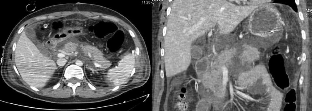 366 Il giornale italiano di Radiologia Medica (2014) 3: 361-367 Fig. 8 Transezione del corpo del pancreas con ematoma perighiandolare. Fig. 9 MVA con fratture costali e dell ala iliaca.