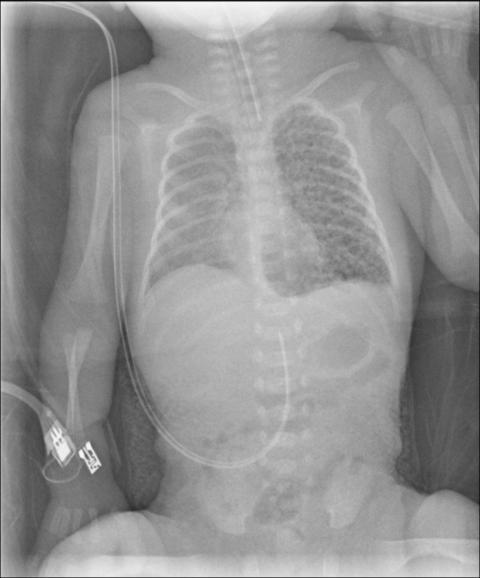 Diagnosi Radiologica Del Pneumotorace Neonatale Pdf