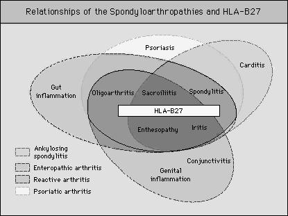 COMPARISON OF THE SPONDYLOARTHROPATHIES FEATURE ANKYLOSING POST-URETHRAL POST-DYSSENTERIC ENTEROPATHIC PSORIATIC SPONDYLITIS REACTIVE REACTIVE ARTHRITIS ARTHRITIS ARTHRITIS ARTHRITIS Sacroiliitis