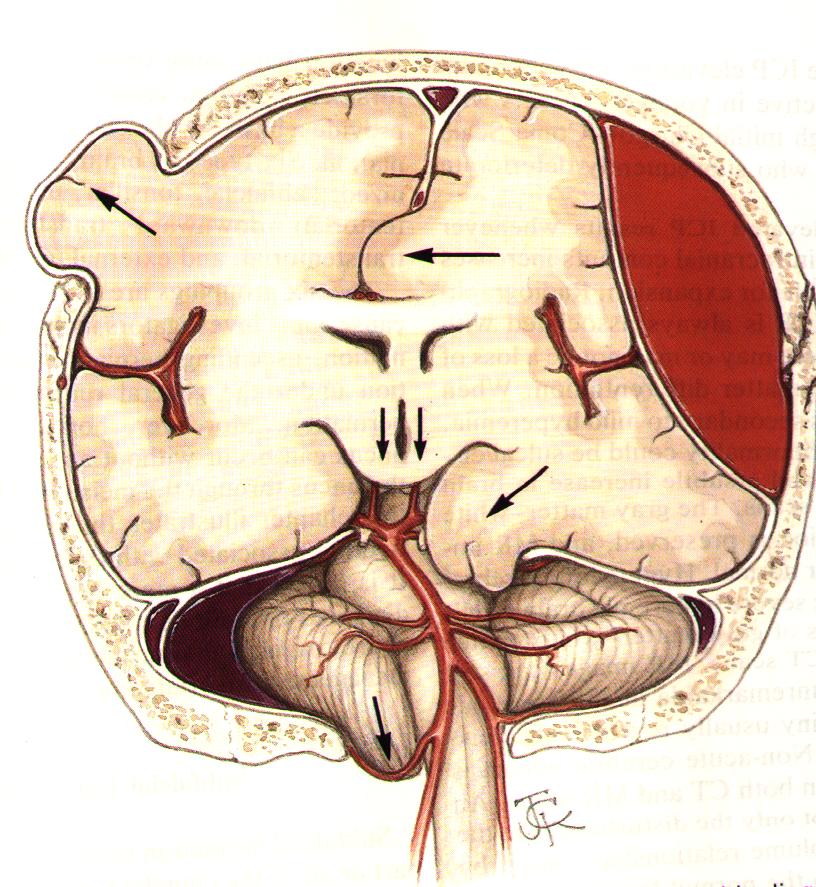 SINDROME UNCALE Ematoma