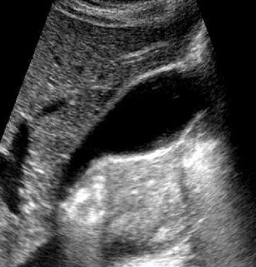 Colangio-RMN Esami di terzo livello Colangio-pancreatografia