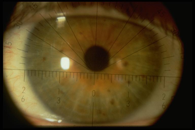 Scelta del Rb Di solito i Rb dei 2 occhi non differiscono di molto, tranne Altri fattori importanti da rivedere spessore lente, potere, tensione palpebrale.
