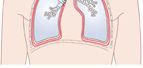 I POLMONI Ogni polmone è circondato da una doppia membrana chiamata pleura.