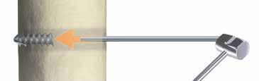 L'utilizzo e la forza con cui si utilizza il martello a diapason sono a discrezione del chirurgo.
