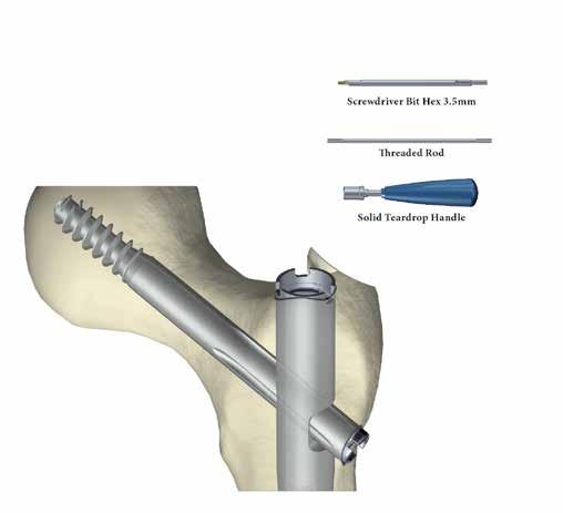 Tecnica chirurgica Set estrazione impianto Tecnica chirurgica Vite cefalica Viene praticata un'incisione sull'estremità