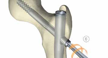 Tecnica chirurgica Tecnica chirurgica Set estrazione impianto Verificare che la crescita ossea verso l'interno non ostruisca l'inserimento sicuro del dispositivo di estrazione, altrimenti l'impianto