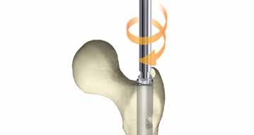 Se la crescita ossea verso l'interno ostruisce l'accesso al chiodo, utilizzare un carotatore, una pinza (non fornita) o una curette (non fornita) per creare un accesso.