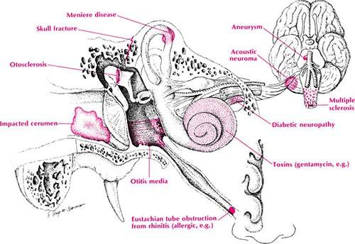 Fig. Le possibili cause di un abbassamento di udito (ipoacusia), oltre alla perforazione timpanica e all otite cronica semplice e colesteatomatosa.