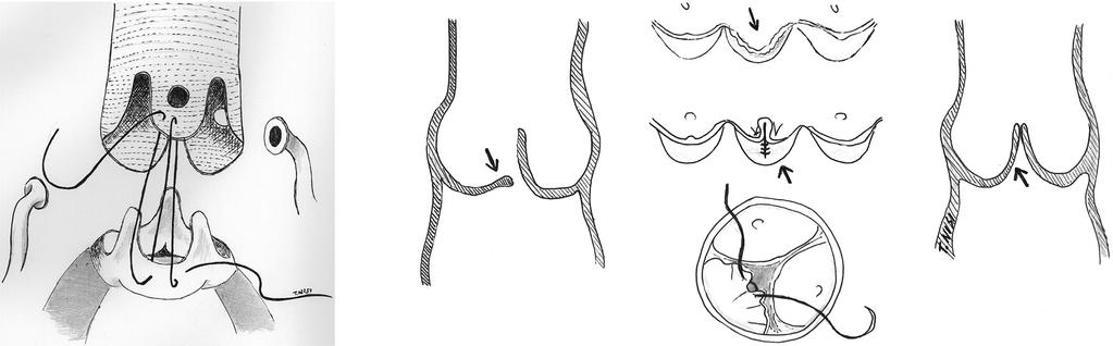 M DE BONIS ET AL A B Figura 1. A: intervento di Yacoub (rimodellamento della radice aortica). B: plicatura centrale di cuspide aortica prolassante. Figura 2.