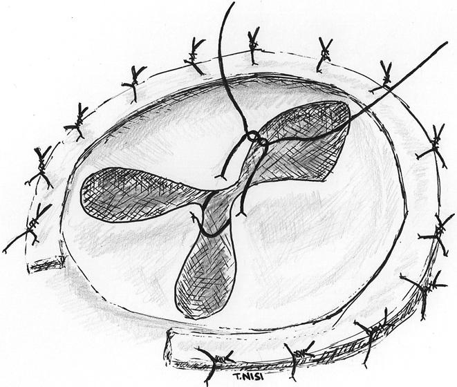 M DE BONIS ET AL Tabella 2. Studi di confronto tra anuloplastica tricuspidale con anello e anuloplastica con sutura. Autore N.