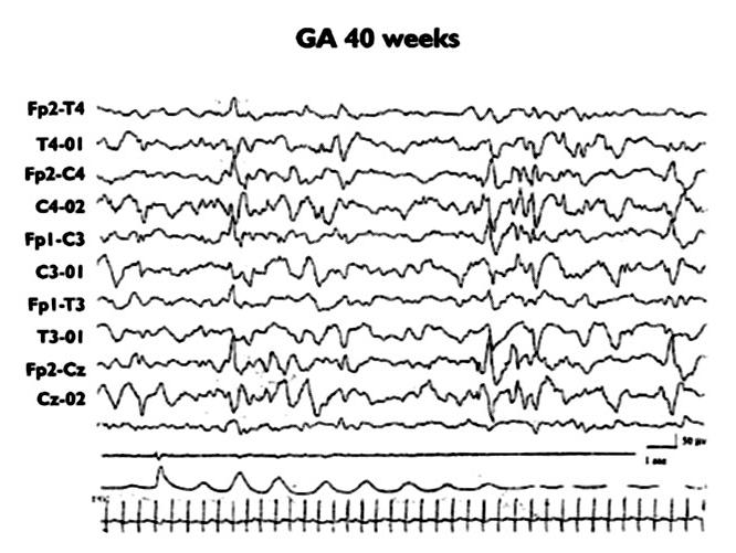 EVENTI MATURATIVI DELL ATTIVITA ELETTRICA CEREBRALE EG 25 settimane IDENTIFICAZIONE DEI RISCHI NEUROLOGICI ED ESITI A DISTANZA EG 28 settimane Fase di sonno quieto Tracciato