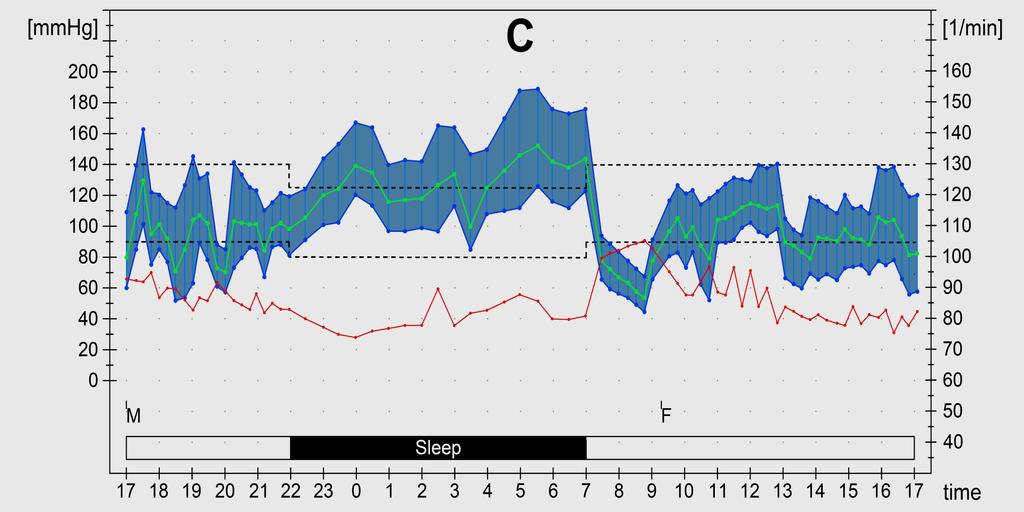 >120/70 mmhg Reduced or non-dipping ( 10%)