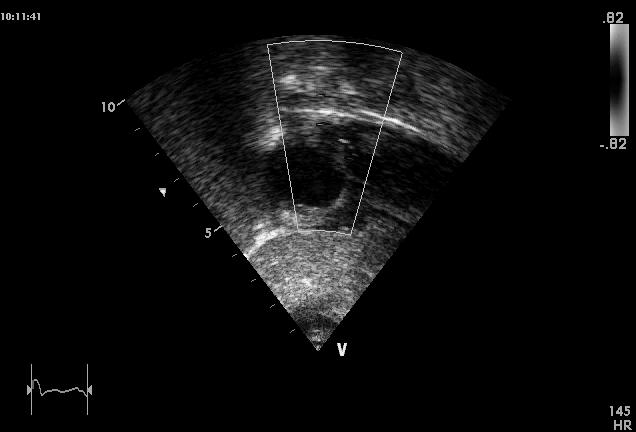 Ruolo dell Ecocardiografia fetale nella diagnosi di DIA Il DIA os o la persistenza del FOP non possono essere diagnosticate in utero IL DIA op (associato o meno a DIV) può essere diagnosticato.