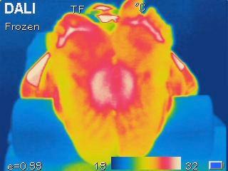 in realtà una forte infiammazione nella zona metatarsale che le