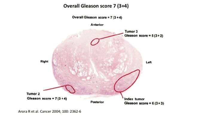 4 Optimizing survival in advanced prostate cancer In conclusione, i dati emersi dai differenti studi clinici indicano una possibile via da seguire per migliorare la sopravvivenza dei pazienti con