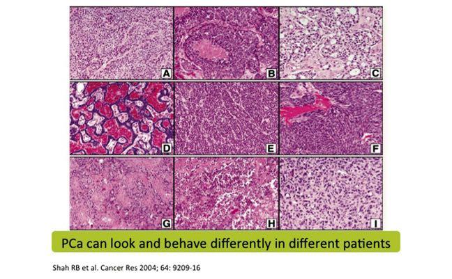 diverse sottoclassi molecolari, sia nelle metastasi (forme avanzate) in cui svolgono un ruolo importante i seguenti fattori: Complessità genomica; Blocco androgenico; Resistenza alle terapie;