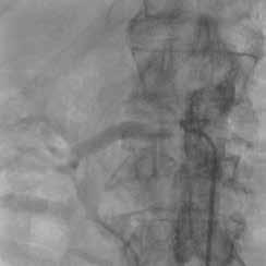 La difficoltà di posizionare in modo preciso uno stent nelle lesioni aorto-ostiali In uno studio retrospettivo condotto su 100 pazienti sottoposti al posizionamento di uno stent mediante punti di