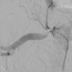 1 I punti di repere angiografici convenzionali, usati nel posizionamento di uno stent nelle lesioni aorto-ostiali, sono spesso imprecisi e/o fuorvianti, rendendo estremamente difficile il