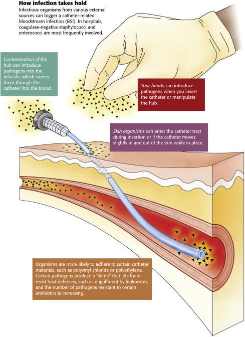 How infection takes hold. ( From Hadaway LC. Infusing without infecting. Nursing 2003;33(10):59; with permission.