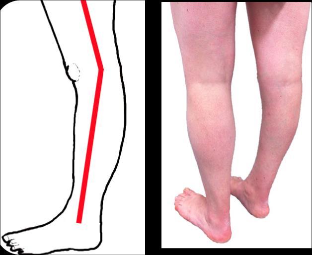 stabilizzare il ginocchio soprattutto posteriormente. Infatti i due gemelli originano leggermente al di sopra dei condili femorali posteriormente e passano a ponte sulla articolazione del ginocchio.