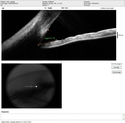 3.7 Eziopatogenesi glaucoma Alcune alterazioni dell angolo viste pre-operatoriamente non sono correlabili all insorgenza del glaucoma (infatti non tutti i pazienti con alterazioni simili sviluppano