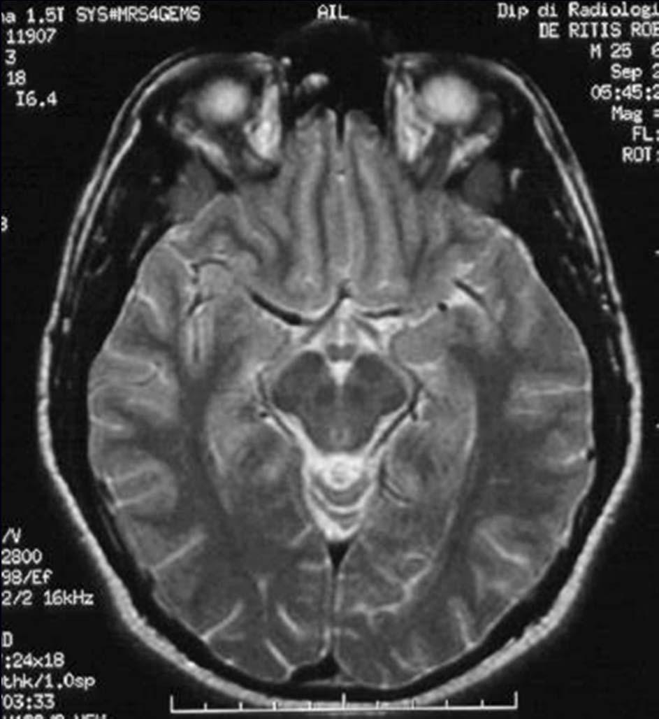 arteria cerebrale media Risonanza