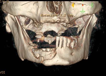 65 yrs Scintigraphy post III