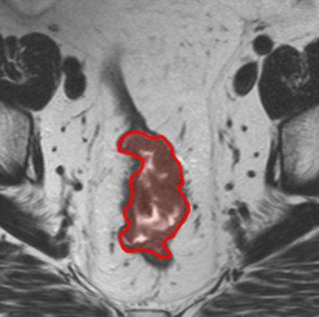 Fig. 5: DWI che dimostra un elevato