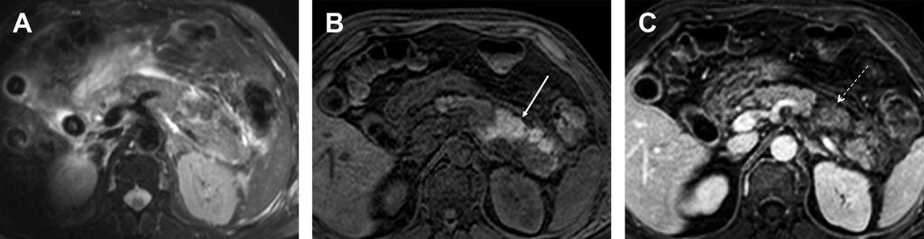 Pancreatite necrotico-emorragica T2 FS Pre-contrast T1 FS Post-contrast T1
