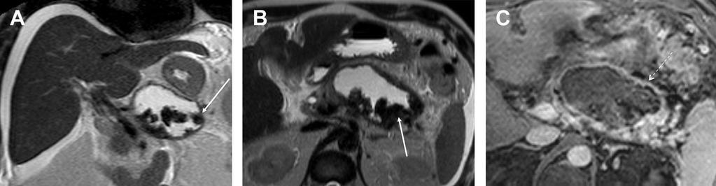 Necrosi walled-off (WON) Coronal T2 Axial T2 Post- contrast FS T1