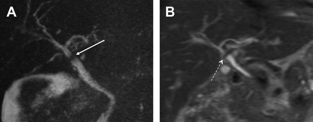 Impronta dell arteria epatica destra Colangio-RM 2D T2-pesata