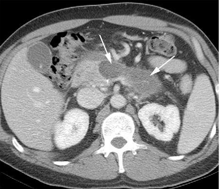 Necrosi parenchimale Aree di non enhancement nel contesto del parenchima pancreatico (tessuto pancreatico