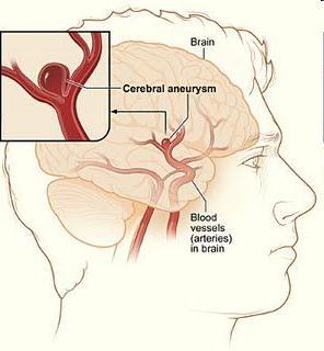 di un'arteria, causata da un'anomalia della parete del