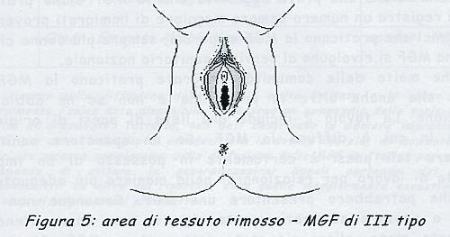 MGF III