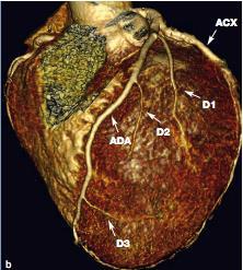 Arteria discendente anteriore L'arteria discendente anteriore (Fig.