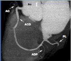 antero-laterale del tratto di efflusso del ventricolo destro. In una piccola percentuale di casi questo ramo origina separatamente dall aorta ascendente in prossimità dell ostio della ACD.