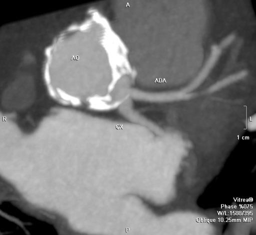 ADA e CX può rappresentare una difficoltà nell'esecuzione dell'angiografia [37].