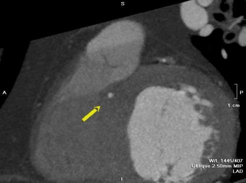 Figura 7: Arteria coronaria singola di un paziente di 83 anni con coronarie estesamente calcifiche; con origine dal seno coronarico di destra e decorso intramiocardico Sebbene la coronaria singola