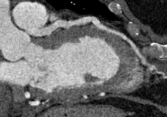 Figura 8: Origine anomala del tronco comune sinistro dall'arteria polmonare in un paziente di 48 anni con dispnea da sforzo, cardiopalmo e insufficienza cardiaca congestizia; coesiste dilatazione dei